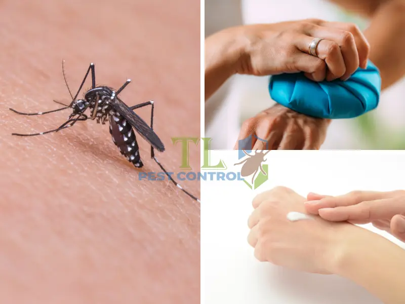Chườm lạnh, bôi kem chứa kháng histamin nhẹ khi bị muỗi vằn đốt