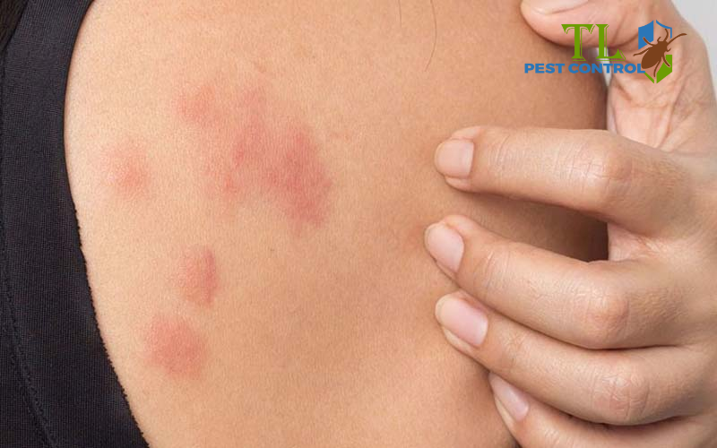 Cách xử lý vết cắn kiến cánh tại nhà hiệu quả