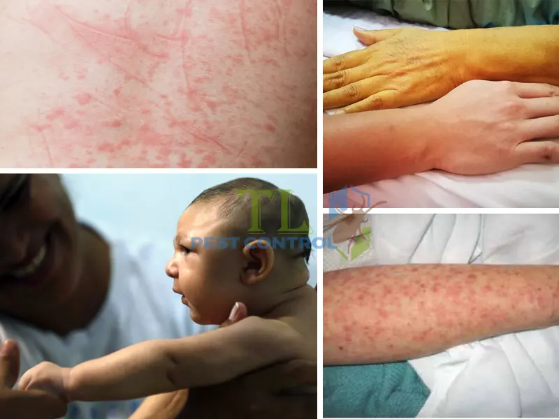 bị muỗi vằn đốt có sao không