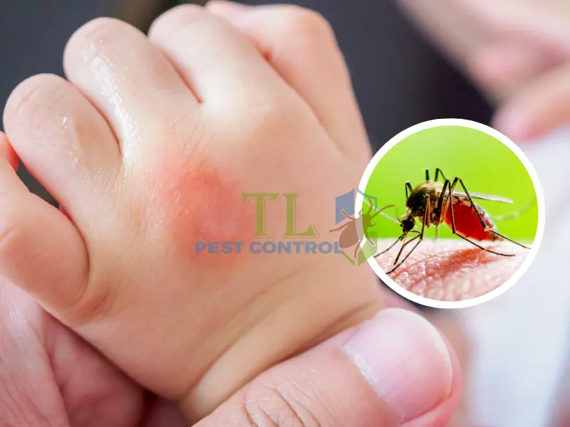 bị muỗi độc đốt sưng to