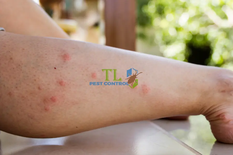 Bị Muỗi Độc Đốt Sưng To: Nguyên Nhân, Cách Xử Lý Hiệu Quả 